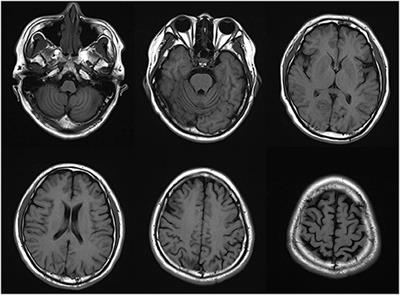 Case Report: A case of PLA2G6 gene-related early-onset Parkinson's disease and review of literature